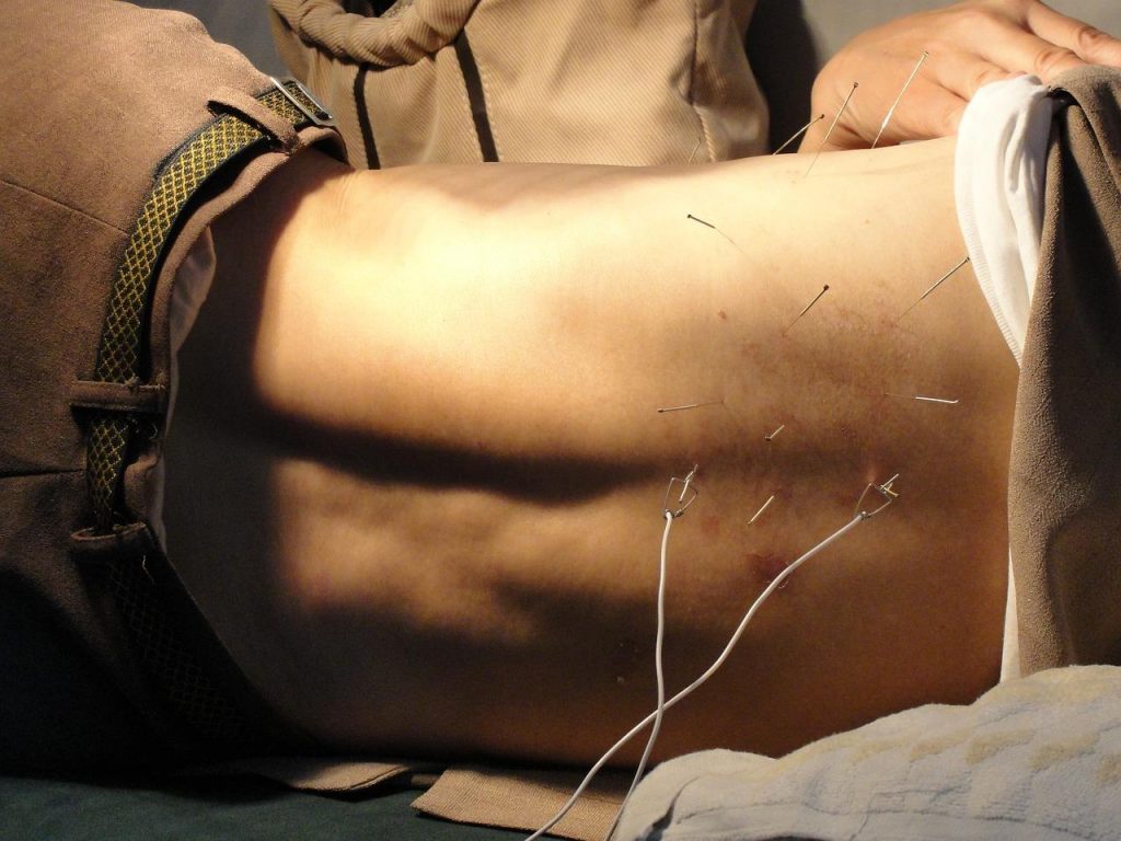 Acupuncturist voert behandeling uit met naalden op acupunctuurpunten voor pijnverlichting en welzijn in Emmen