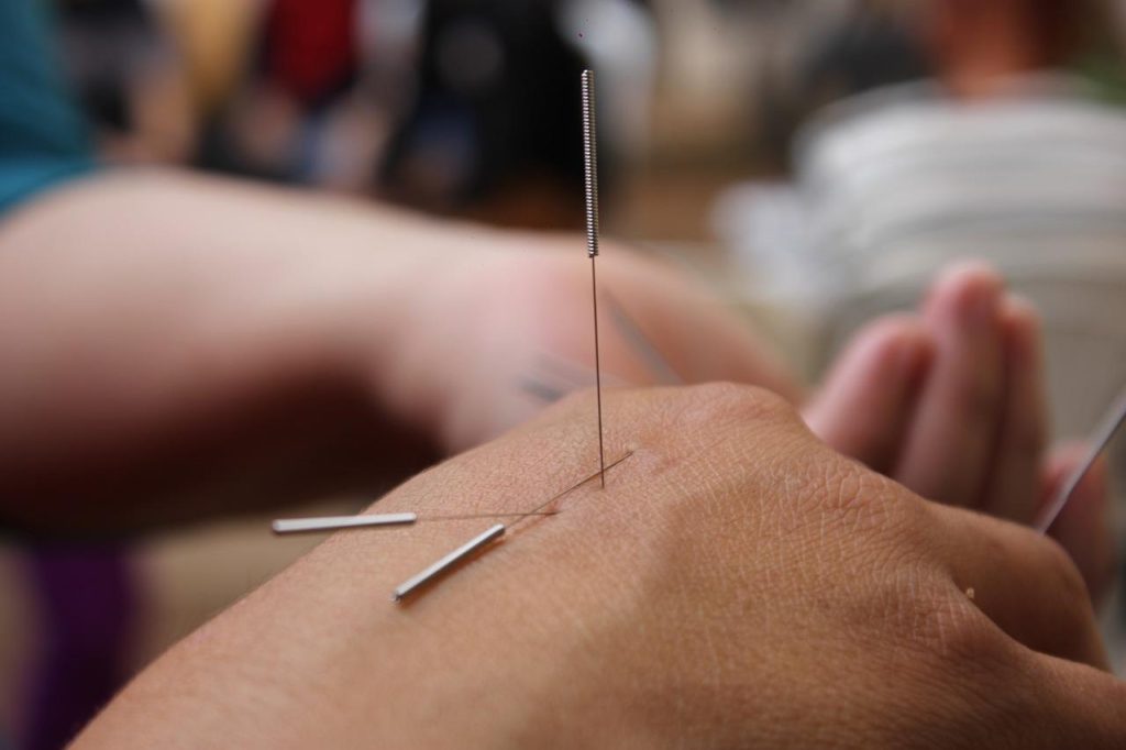 Acupuncturist Oosterhout toont behandelruimte met patiënt ontspannen op behandeltafel met acupunctuurnaalde behandeling